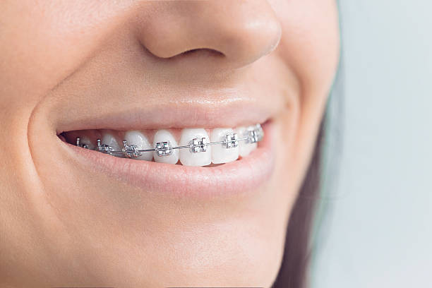 Best Dental Bonding  in Highlands, TX